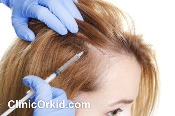 مزایای مزوتراپی مو | کلینیک ارکید