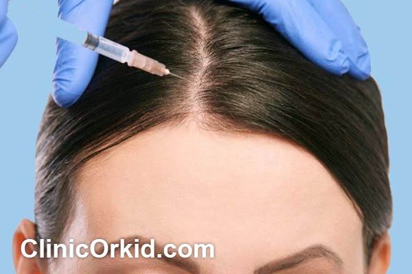 مزوتراپی مو مناسب چه کسانی است؟ | کلینیک ارکید