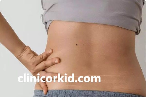 مراحل درمان ترک های پوستی با استفاده از لیزر | کلینیک ارکید