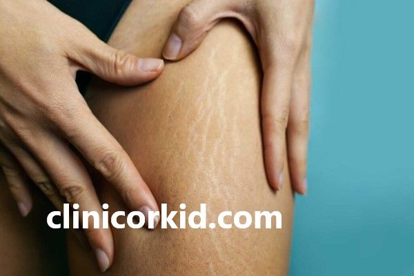 دلیل پیدایش ترک پوستی | کلینیک ارکید