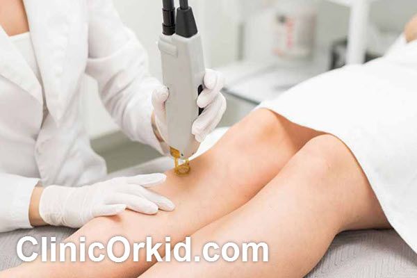 بهترین دستگاه لیزر برای پوست سفید در پونک | کلینیک ارکید