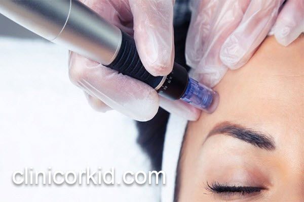 میکرونیدلینگ صورت توسط بهترین پزشک در غرب تهران | کلینیک ارکید
