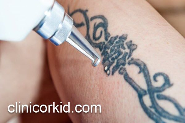 تکنیک های جدید پاک کردن تاتو | کلینیک ارکید