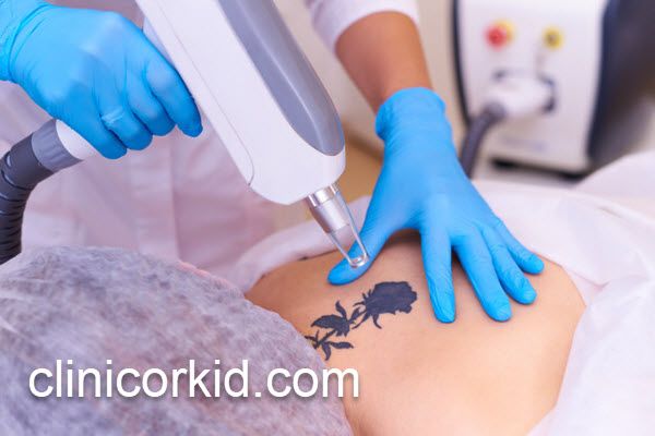 پاک کردن تاتو با بهترین روش | کلینیک ارکید