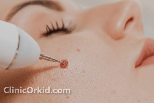 عوامل مؤثر بر هزینه برداشتن خال مادرزادی