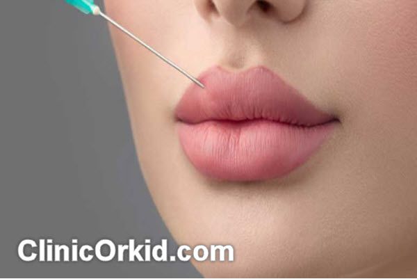 مزیت های تزریق ژل لب | کلینیک ارکید