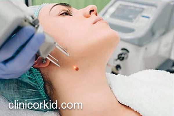 هزینه برداشتن خال با لیزر در سال 1403 | کلینیک ارکید