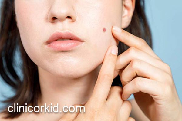 رفع خال های بزرگ صورت در کلینیک تخصصی | کلینیک ارکید