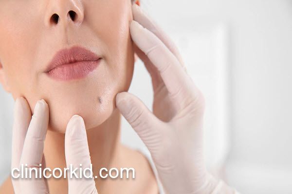 برداشتن خال های بزرگ در کلینیک معتبر | کلینیک ارکید