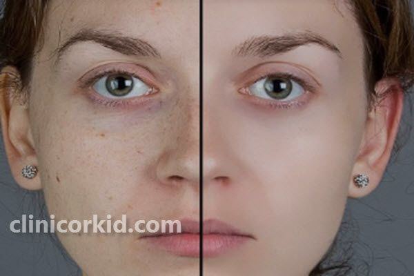 چند جلسه مزوتراپی برای لک صورت لازم است؟