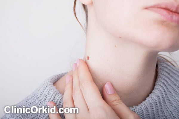 انواع روش های برداشتن صورت | کلینیک ارکید