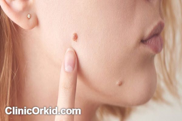 مراقبت های بعد از برداشتن خال صورت | کلینیک ارکید
