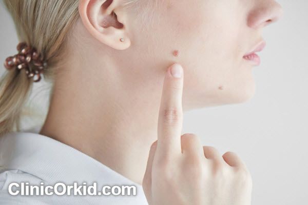 بهترین کلینیک برداشتن خال مادرزادی در پونک | کلینیک ارکید