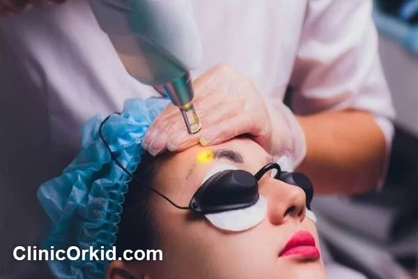 مراقبت های پس از پاک کردن تاتو با لیزر کیوسوئیچ | کلینیک ارکید