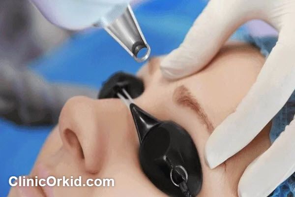 پاک کردن تاتو ابرو با لیزر کیوسوئیچ | کلینیک ارکید