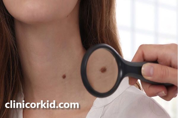 برداشتن خال های مادرزادی چگونه انجام می شود؟