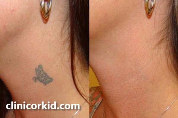 تعداد جلسات پاک کردن تاتو با لیزر کیوسوئیچ چقدر است؟