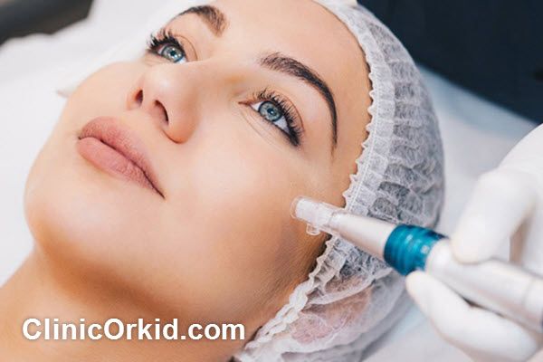 هزینه میکرونیدلینگ در سال 1404 چقدر است؟ | کلینیک ارکید