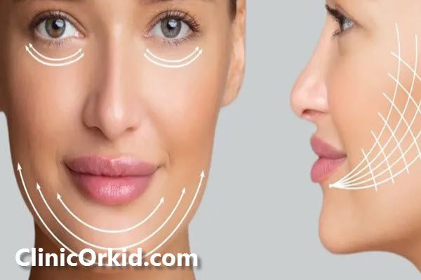 اندولیفت چیست؟ | غرب تهران