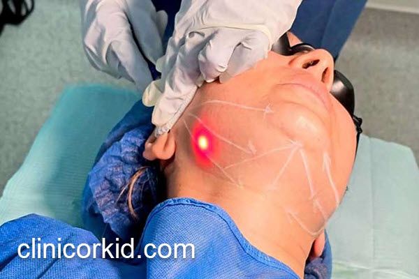 مرکز تخصصی اندولیفت در پونک | کلینیک ارکید