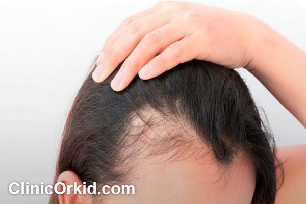 ویژگی های بهترین کلینیک مزوتراپی مو