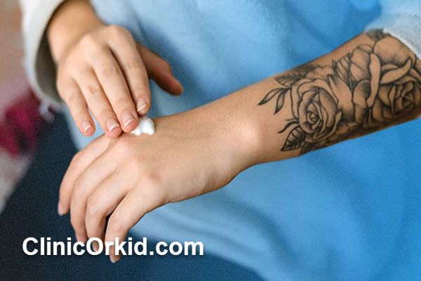 هزینه پاک کردن تاتو با لیزر چقدر است؟