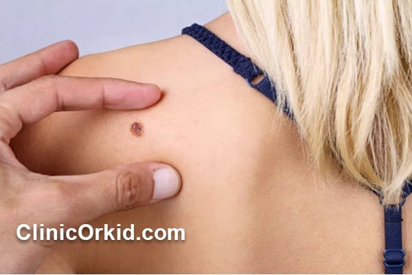 هزینه برداشتن خال چقدر است؟