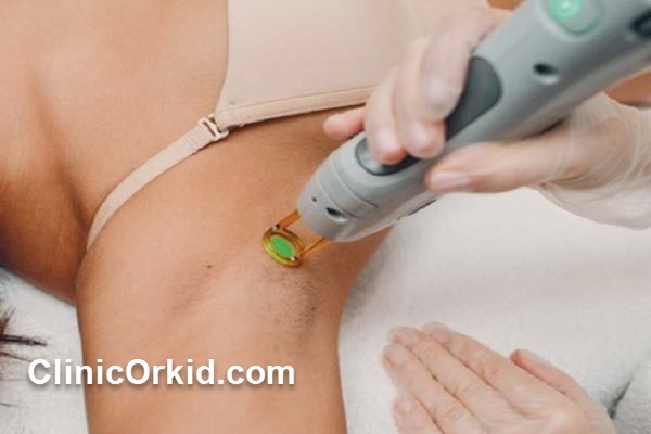 چه کسانی کاندید مناسب لیزر الکساندرایت هستند؟