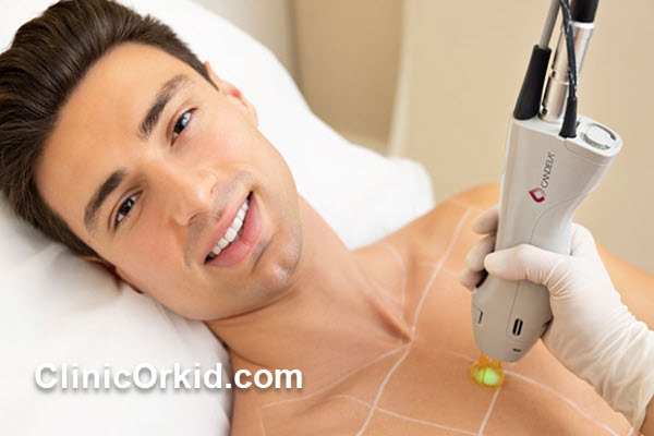 نکات مهم قبل و بعد از لیزر الکساندرایت