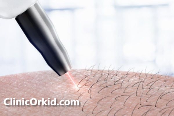 آیا لیزر دست درد دارد؟ | کلینیک ارکید