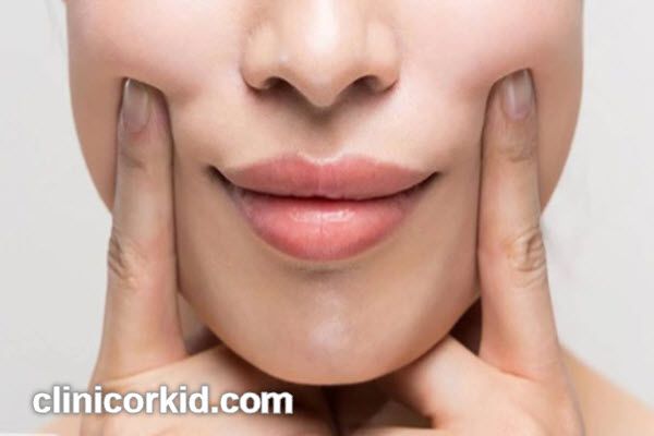 ماندگاری تزریق ژل خط خنده چقدر است؟