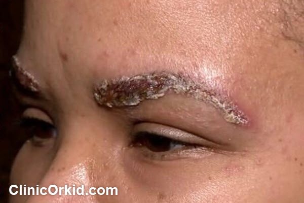 مقایسه هزینه لیزر با سایر روش های پاک کردن تاتو