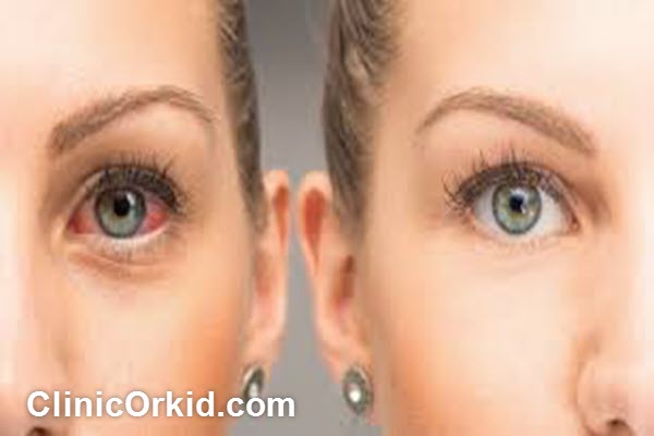 مزایای هایفوتراپی دور چشم