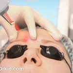 هزينه پاک كردن تاتو ابرو با ليزر چقدر است؟
