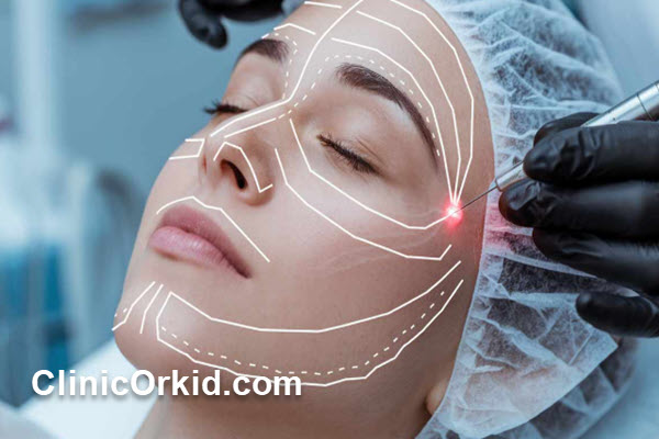 اندولیفت چیست و چگونه انجام میشود؟